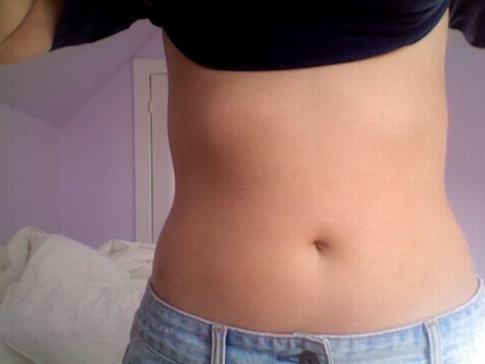 Rezultat tretmana NEOflorax kapsulama