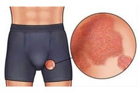 Schistomatosis utječe na ljudske genitalije, uzrokujući jak svrbež